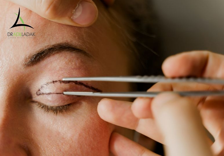 Signs It May Be Time to Consider Eyelid Surgery - Eyelid Surgery Edmonton